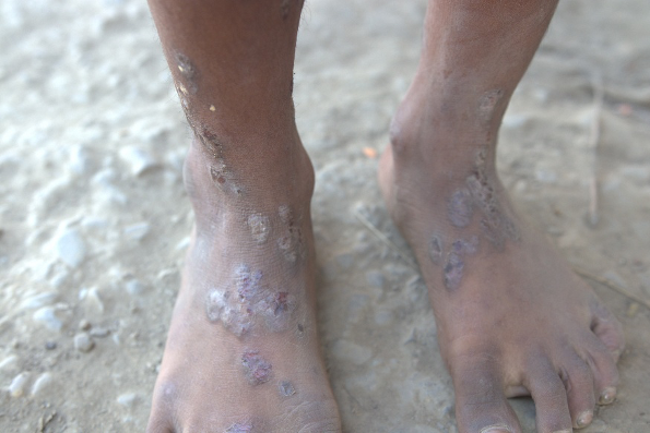 Kyaukphyu_Skin Disease